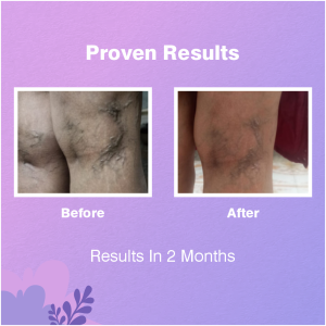 Varicose Veins Lotion Results