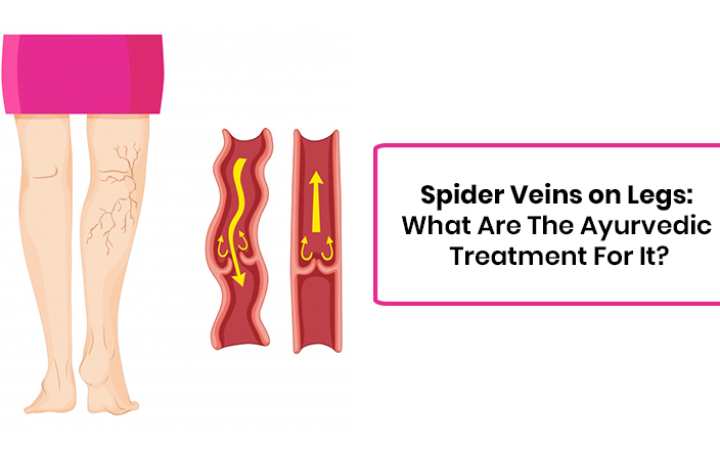 Spider-Veins-on-Legs-What-Are-The-Ayurvedic-Treatment-For-It