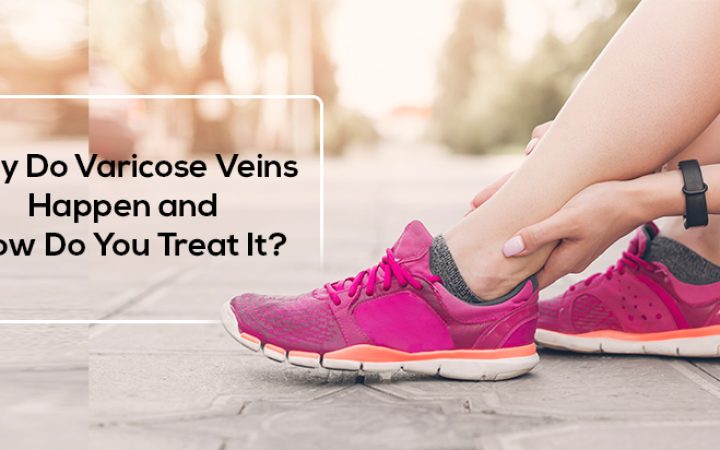 Why-Do-Varicose-Veins-Happen-and-How-Do-You-Treat-It