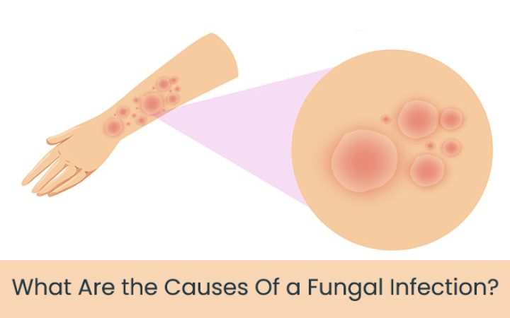 what-are-the-causes-cf-a-fungal-infection
